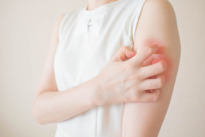 Woman itching her red and sore arm