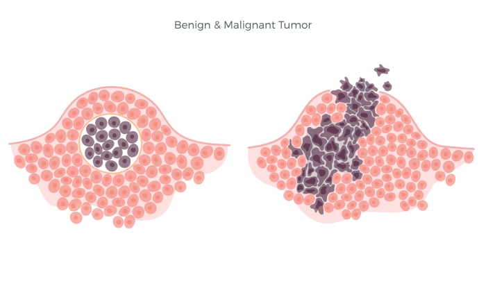 Image of tumours