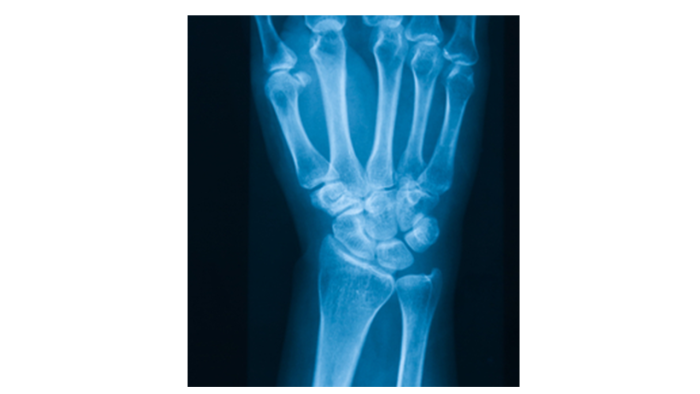 Image of x-ray of the hand and wrist