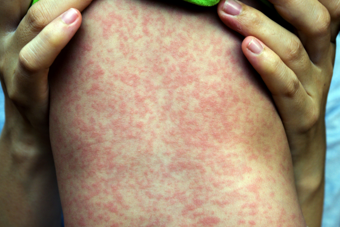 measles rash