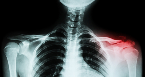 Image of x-ray of the shoulder
