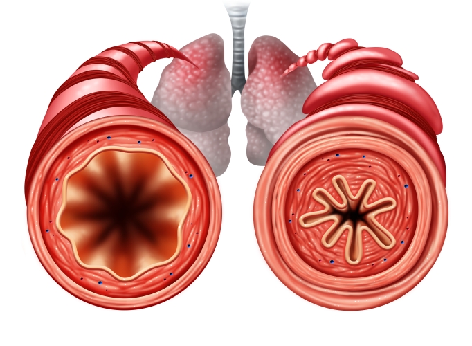 Image of airways that are narrowed in asthma