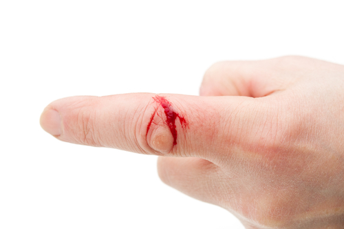 Image of a cut finger