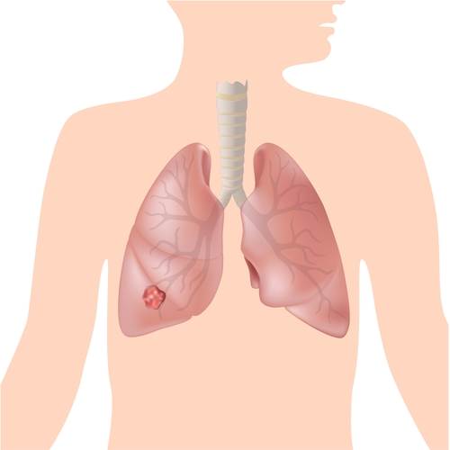 Image of lungs with a tumour in one lung