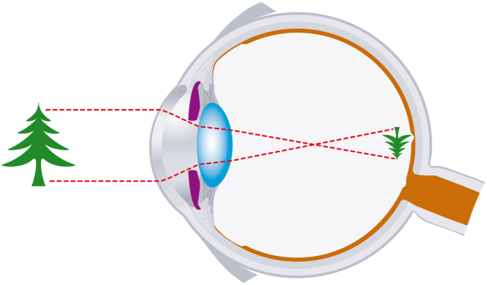 ray diagram of lens focusing image onto retina